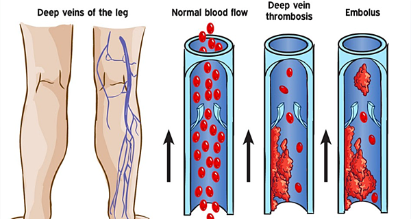 Τι προκαλεί την θρομβοφλεβίτιδα και ποια τα συμπτώματα της; Πώς αντιμετωπίζεται;