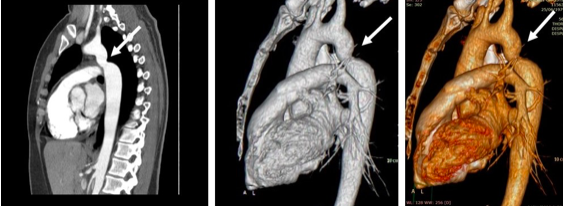 Διάγνωση και διαχείριση σπάνιας συγγενούς ανωμαλίας της αορτής