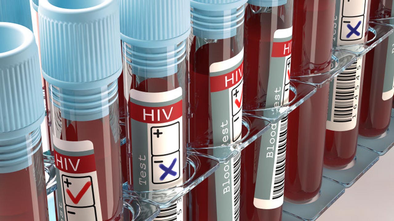 Γυναίκα θεραπεύτηκε από τον HIV μετά από μεταμόσχευση βλαστoκυττάρων