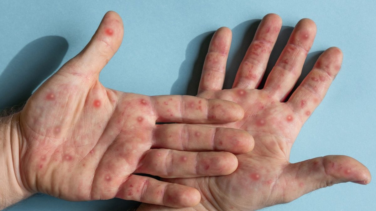 Ιός mpox: Στη δεύτερη θέση η Ελλάδα με τα περισσότερα κρούσματα